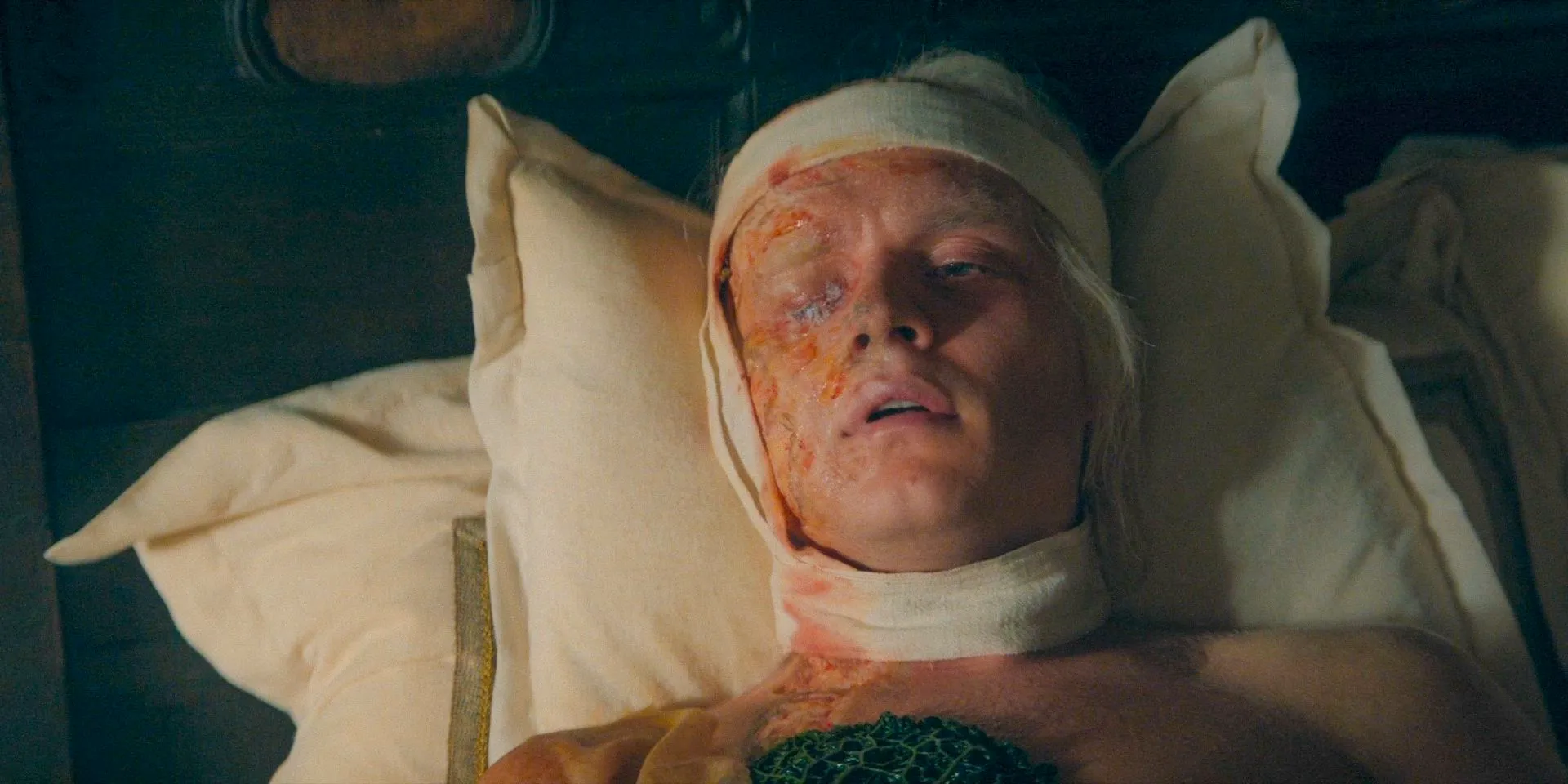 Aegon (Tom Glynn-Carney) in bed recovering from his burns in House of the Dragon Season 2 Episode 6 Image